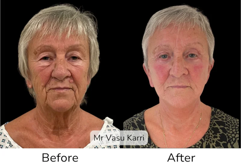 Facelift Patient 10 View 1